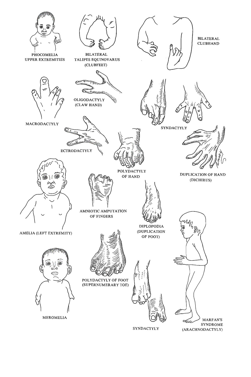 malformations of the  appendicular skeleton (the limbs): image #1