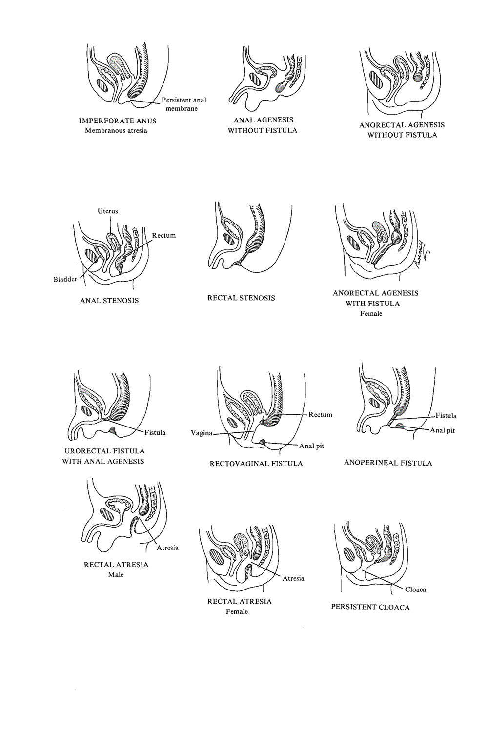 congenital malformations of digestive system: hindgut malformations: image #1